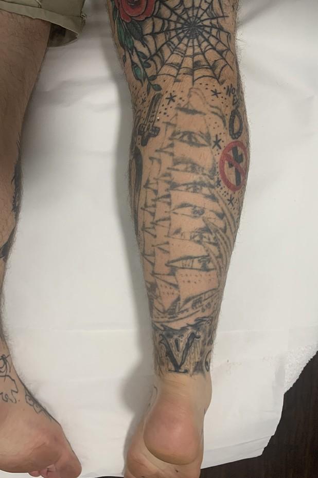 Tattoo - After Image | Tattoo Removal Adelaide