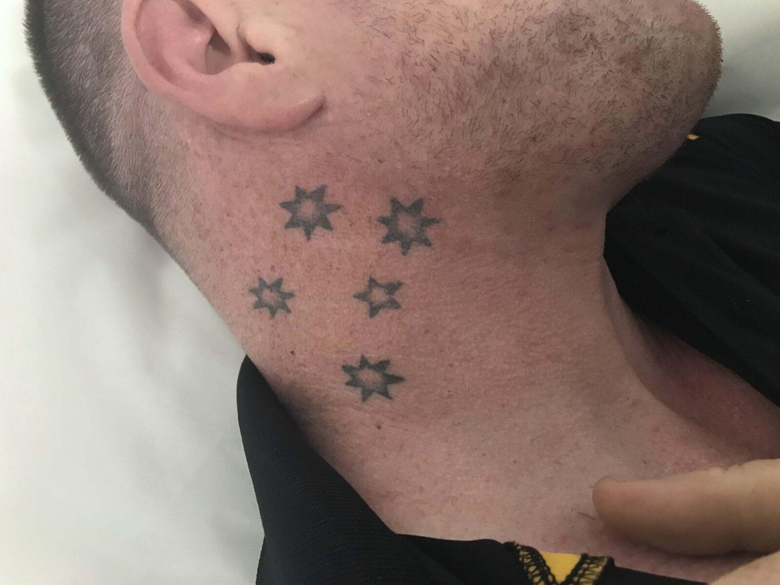 Tattoo - Before Image | Tattoo Removal Adelaide