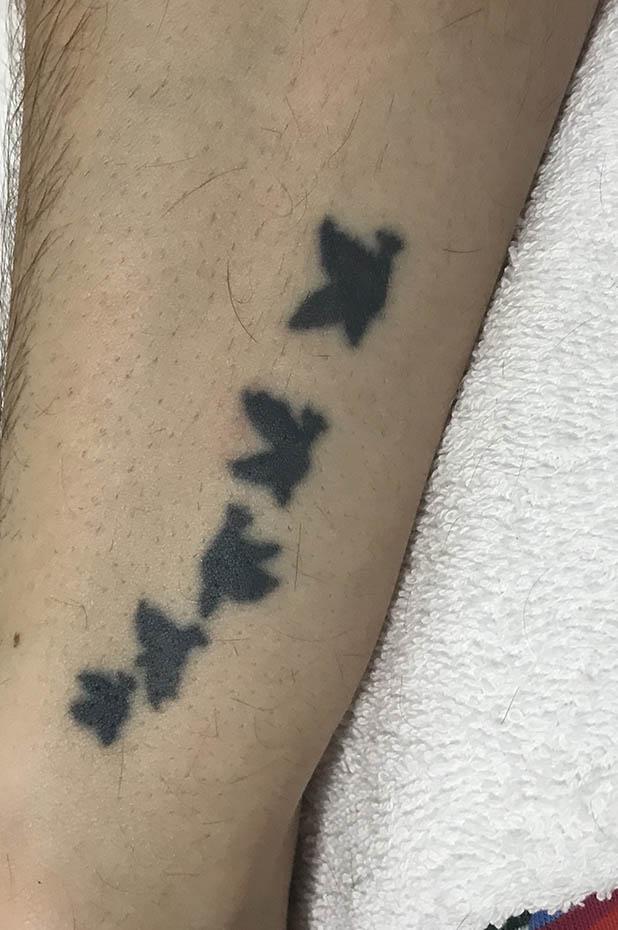 Tattoo - Before Image | Tattoo Removal Adelaide