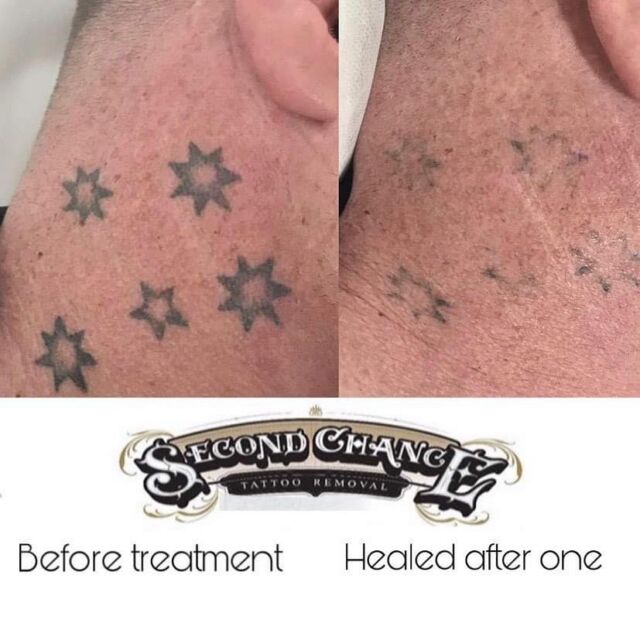 FADE FAST laser tattoo removal Adelaide