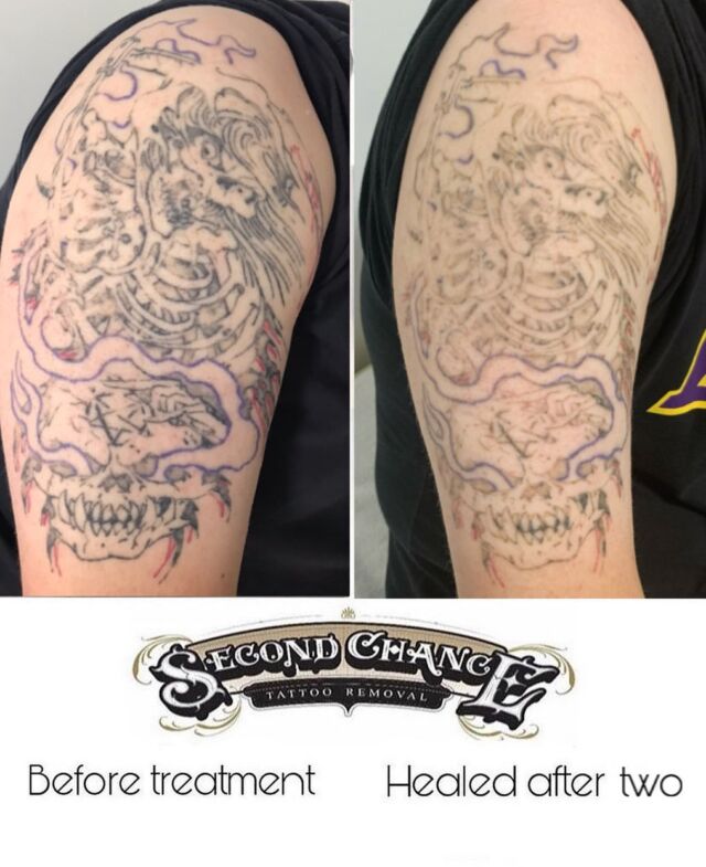 Home - Second Chance Tattoo Removal | Tattoo Removal Adelaide