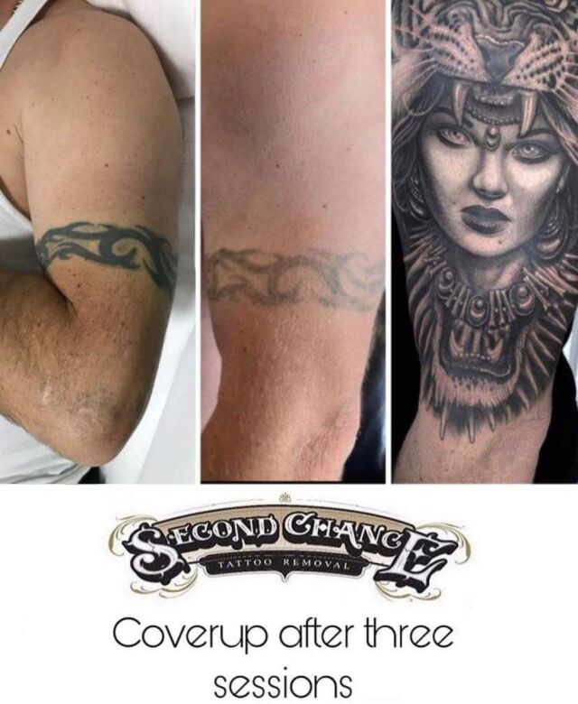 Home - Second Chance Tattoo Removal | Tattoo Removal Adelaide